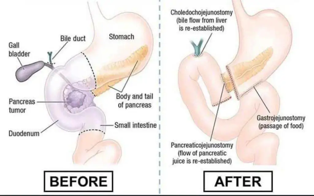 Liver resection surgery pancreatic surgery liver tumor removal liver cancer treatment advanced liver surgery