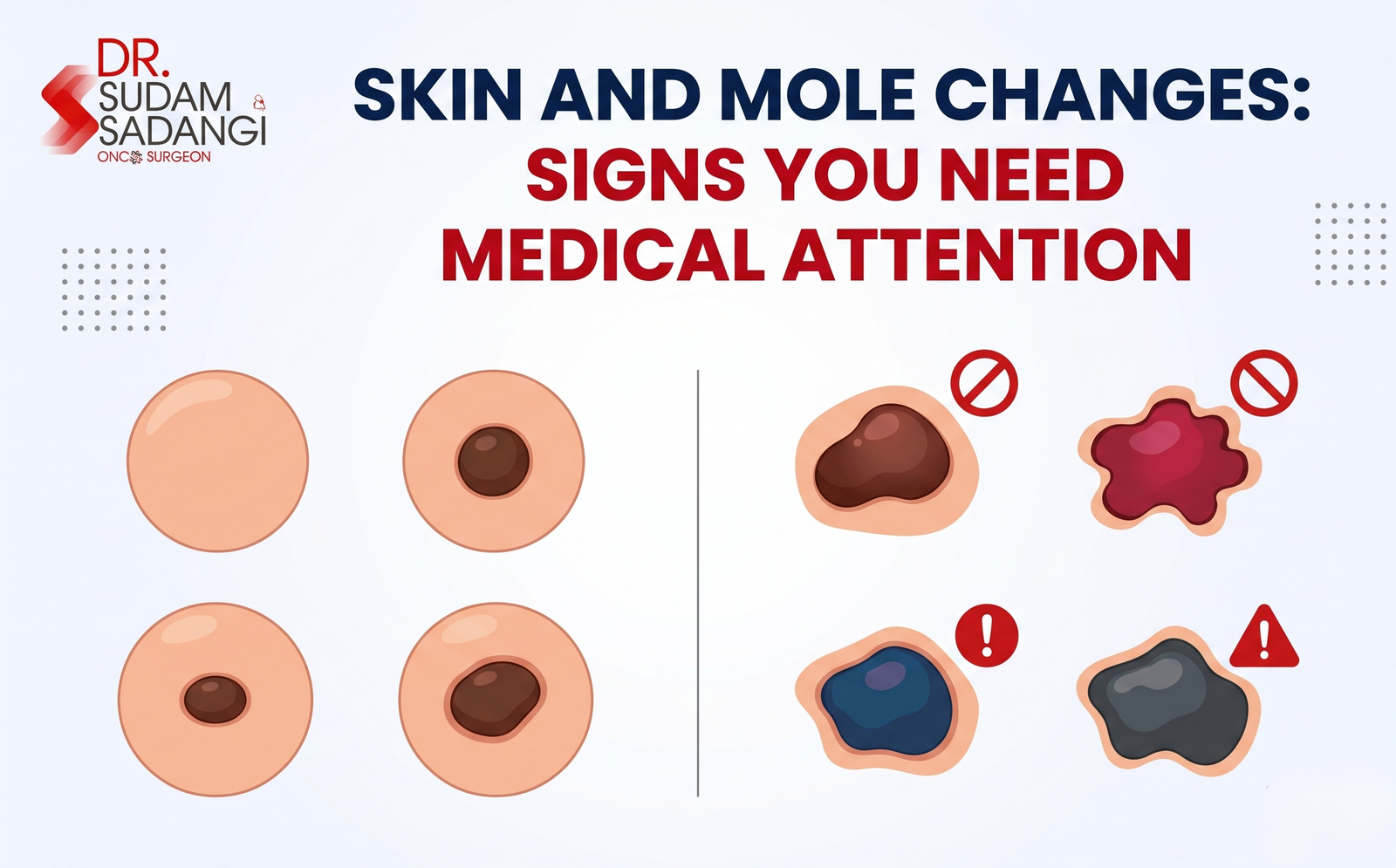 Infographic about skin and mole changes urging medical attention, with visuals of moles changing shape, color, and size and a doctor logo in the corner.