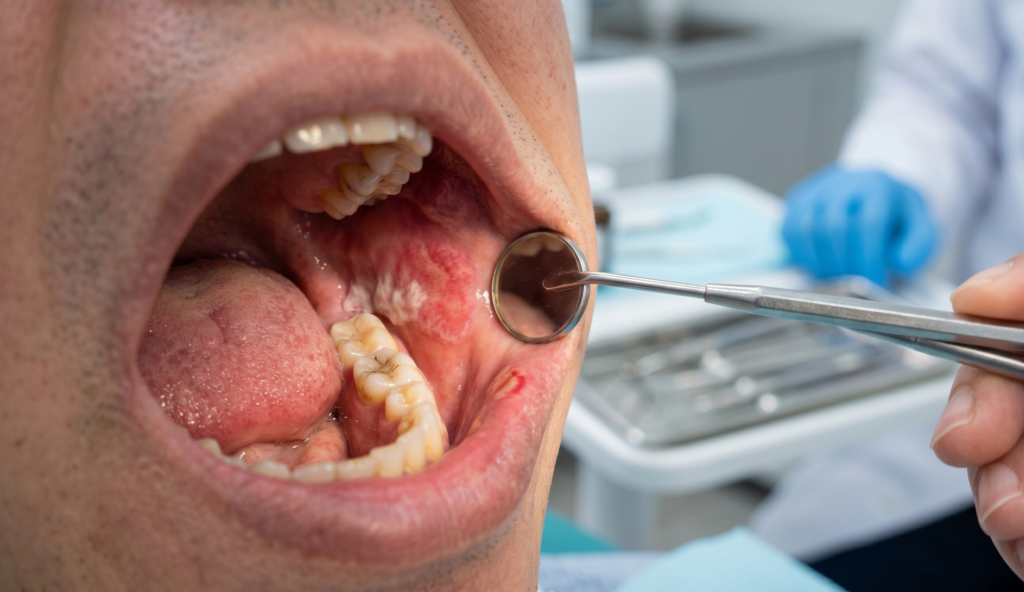Dental exam: a clinician uses a dental mirror and forceps to inspect the lower teeth inside a patient7s open mouth, with visible gums and teeth close up.