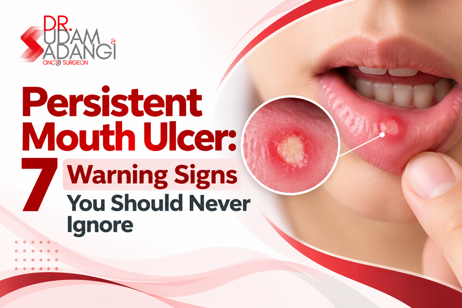 Persistent Mouth Ulcer Warning Signs